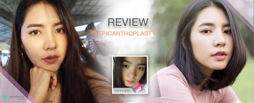 review epicanthoplasty 