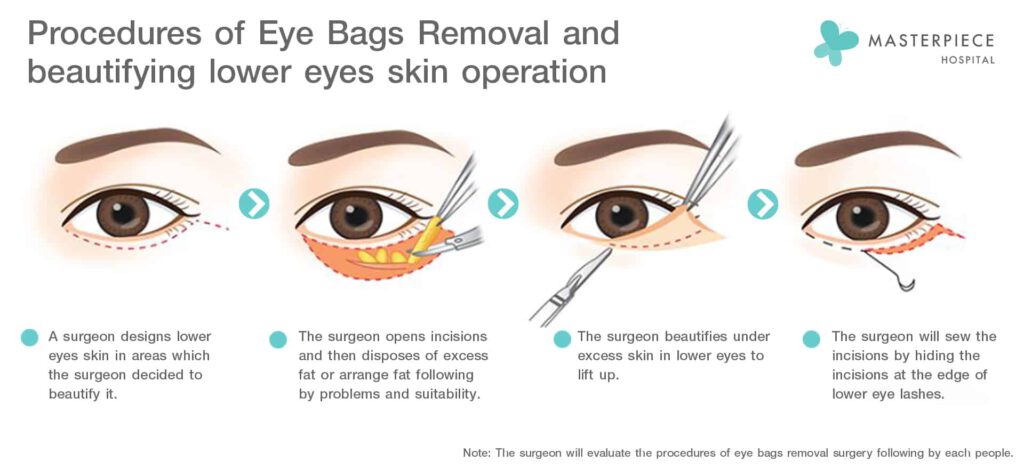 Procedures of Eye Bags Removal and Beautifying Lower Eye Skin Operation