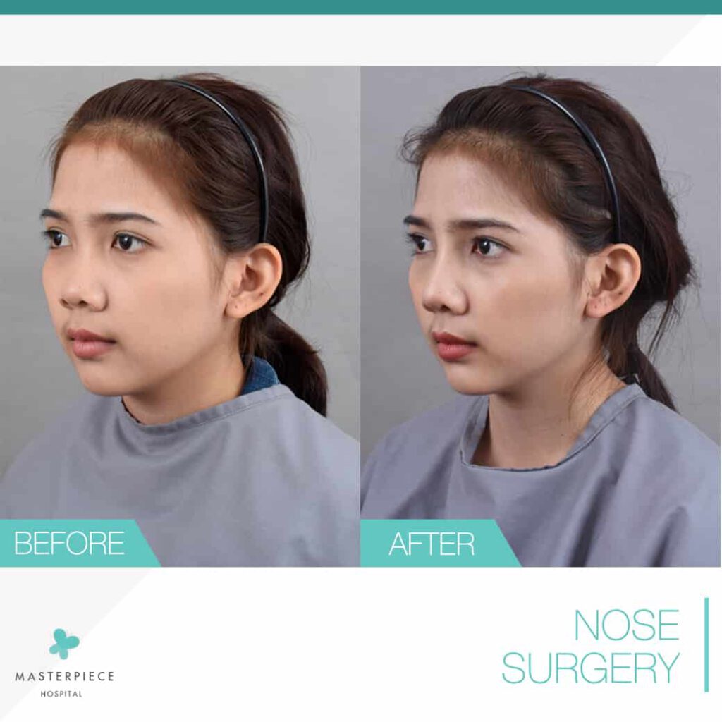 silicone implant with megaderm surgery 4