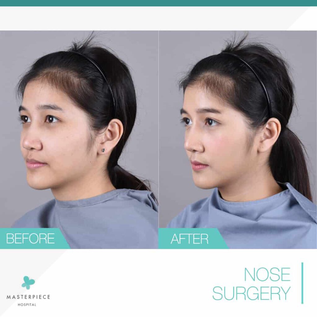 silicone implant with megaderm surgery 3