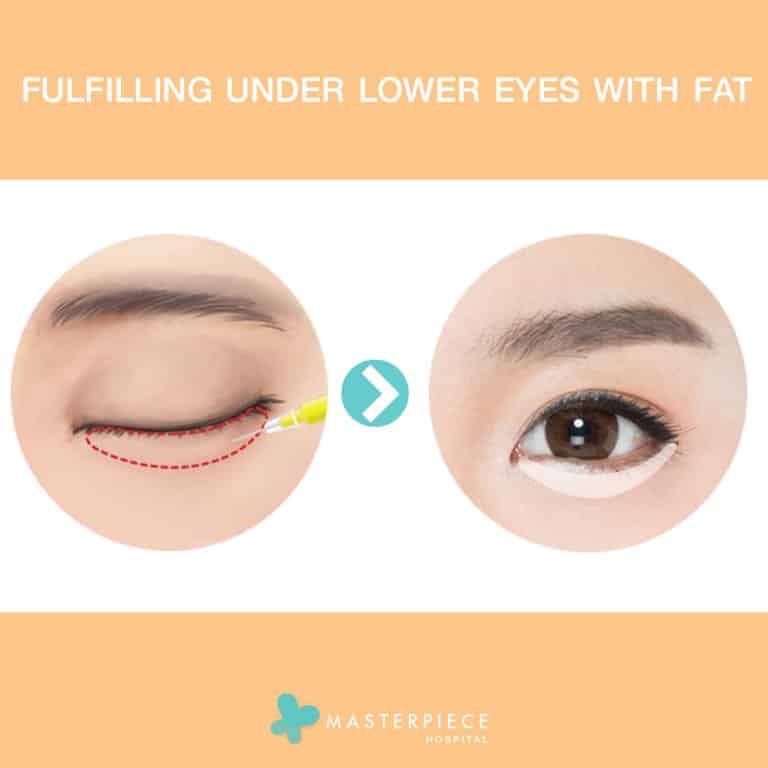 DOLLY EYES PROCEDURE 2